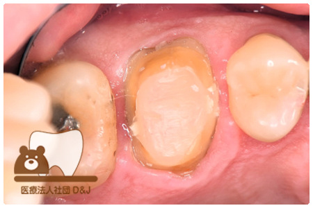 フリジルコニアクラウン　左上6