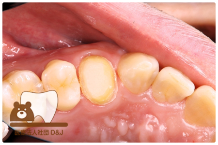 フルジルコニアクラウン　左上4