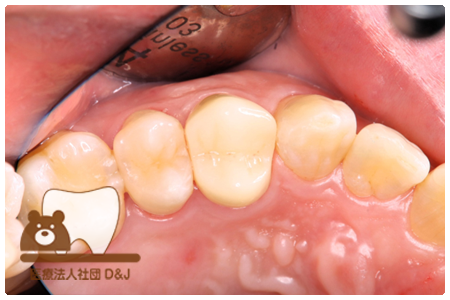 フルジルコニアクラウン　左上4