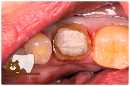 フルジルコニアクラウン　左下6