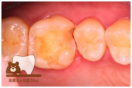 プレスセラミックインレー　左上６