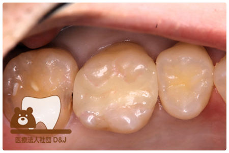 プレスセラミックインレー　左上6
