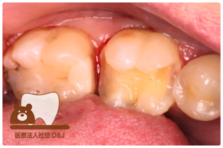 オールセラミックインレー　右下6