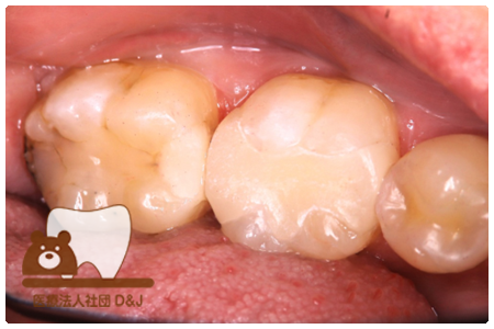 オールセラミックインレー　右下6
