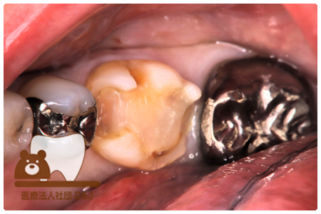 プレスセラミックインレー　左下6