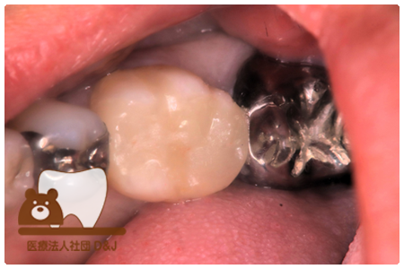 プレスセラミックインレー　左下6