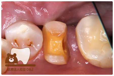 オールセラミックインレー　左下5