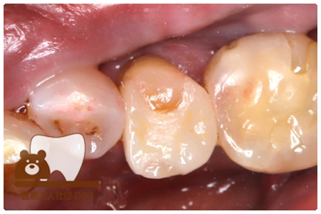 オールセラミックインレー　左下5
