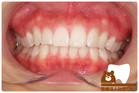 症例1オフィスホワイトニング後の写真