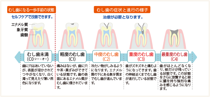 むし歯の進行図