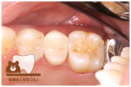 フルジルコニアクラウン治療後の写真