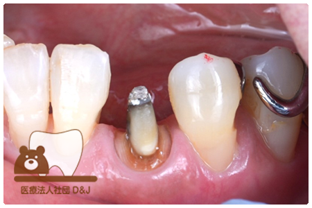 E-maxクラウン　左下3