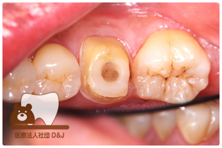 フルジルコニアクラウン　左下6