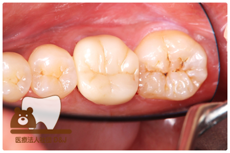 フルジルコニア　左下6