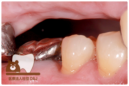 症例1インプラント治療前の写真