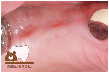 症例1インプラント治療前の写真