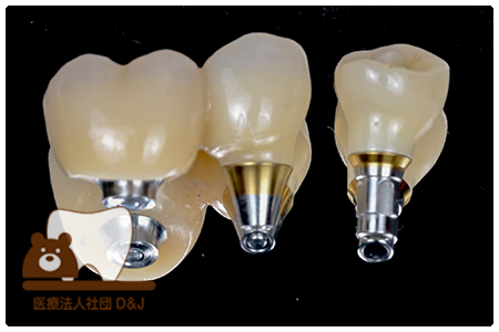 症例1インプラント補綴物の写真