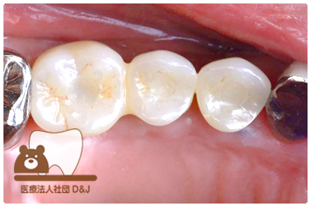 症例1インプラント治療後の写真