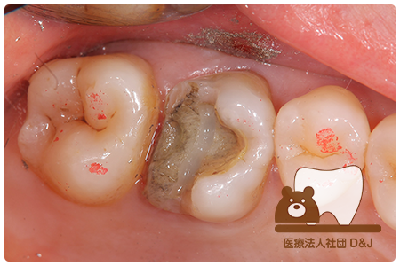 症例1E-maxインレー治療中の写真①