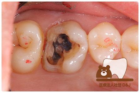 症例1E-maxインレー治療中の写真②