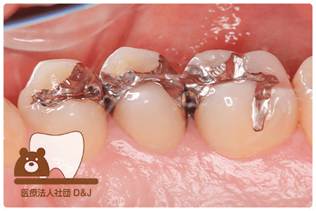 症例3E-maxインレー治療前の写真