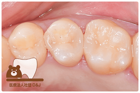 症例3E-maxインレー治療後の写真