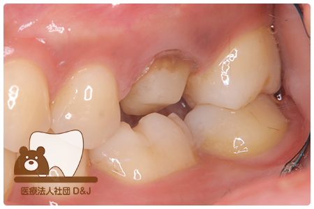 症例5フルジルコニアクラウン治療中の写真