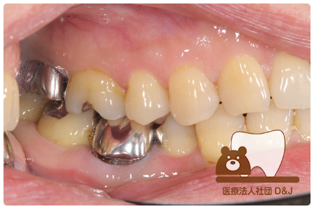 症例6歯牙移植・フルジルコニアクラウン治療前の写真