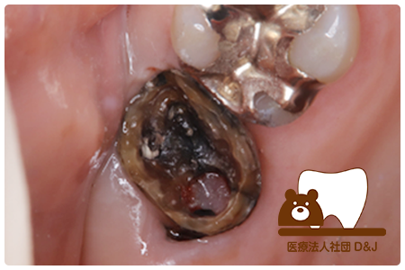 症例6歯牙移植・フルジルコニアクラウン治療中(抜歯前)の写真