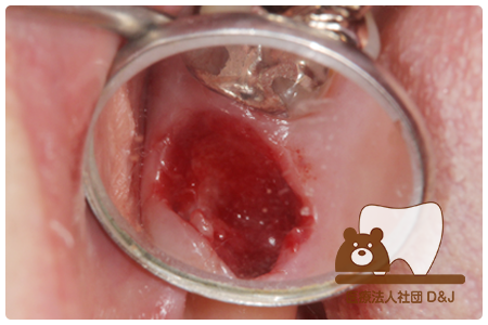 症例6歯牙移植・フルジルコニアクラウン治療中(抜歯後)の写真