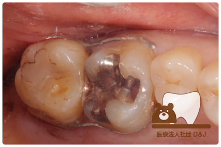 症例6歯牙移植・フルジルコニアクラウン治療中(移植直後)の写真