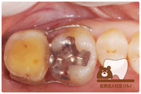 症例6歯牙移植・フルジルコニアクラウン治療中(根管治療)の写真