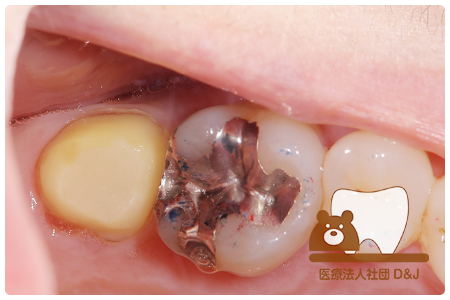 症例6歯牙移植・フルジルコニアクラウン治療中(コア形成後)の写真