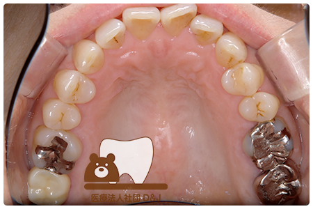 症例6歯牙移植・フルジルコニアクラウン治療後の写真