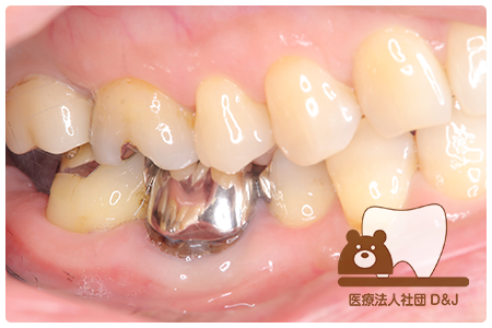 症例6歯牙移植・フルジルコニアクラウン治療後の写真