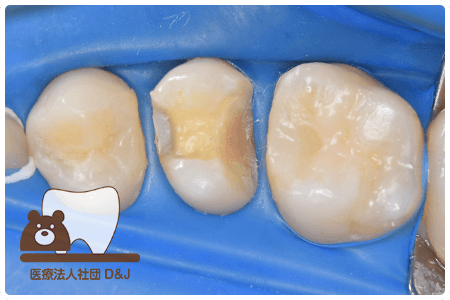 症例3E-maxインレー治療中の写真