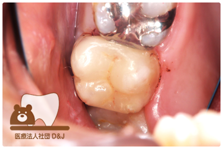 症例8プレスセラミックインレー治療後の写真