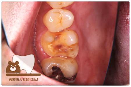 プレスセラミックインレー治療前の写真