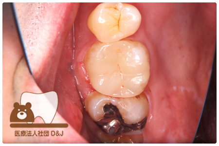 プレスセラミックインレー治療後の写真