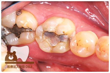 プレスセラミックインレー治療前の写真