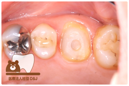 フルジルコニア　右上6