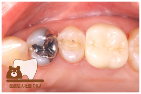 フルジルコニア　右上6