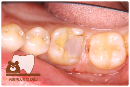 オールセラミックインレー　右下6