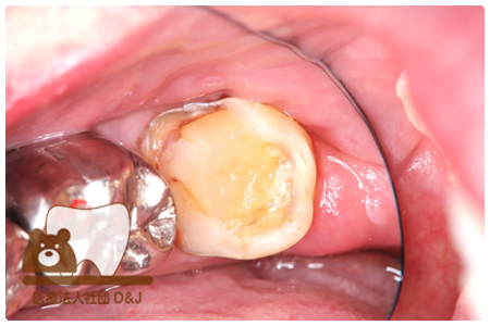 ゴールドインレー　左下7