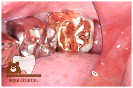 ゴールドインレー　左下7