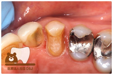 プレスセラミックインレー　右上４