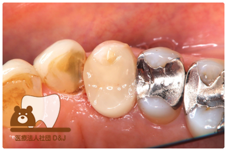 プレスセラミックインレー　右上４