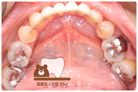 症例1 治療前の写真