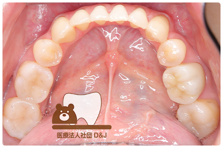 症例1 治療後の写真