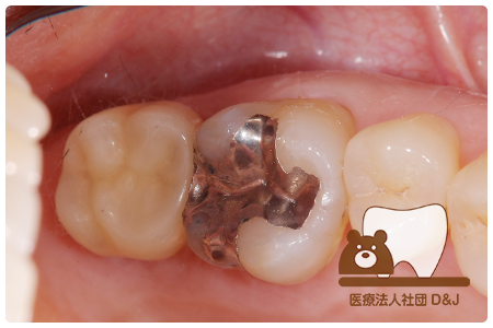 症例3 治療中の写真